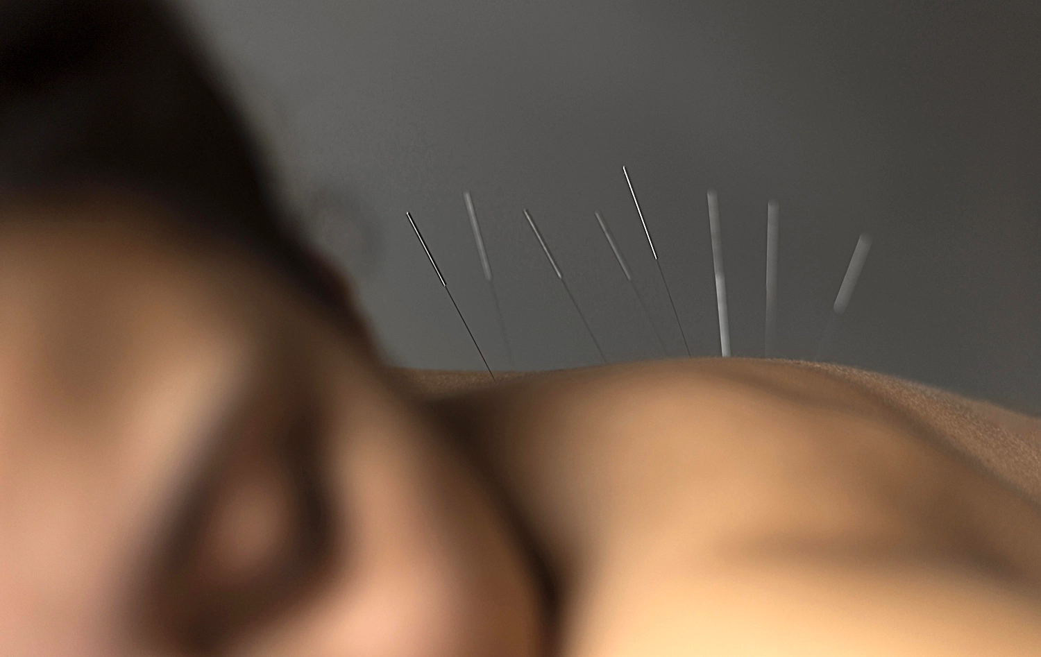 Acupuncture 